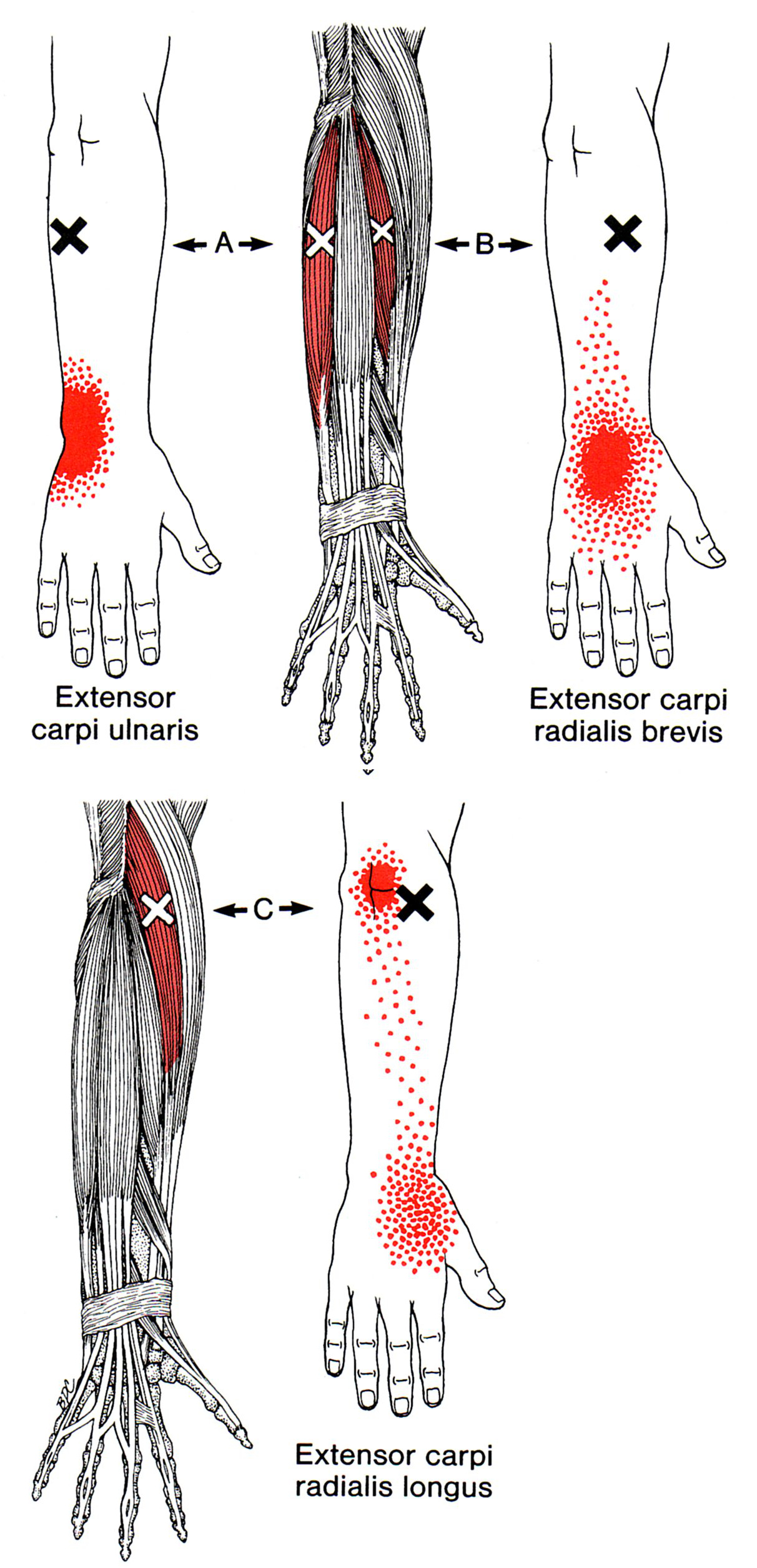 Muscle extenseur ulnaire du carpe : douleurs et trigger points