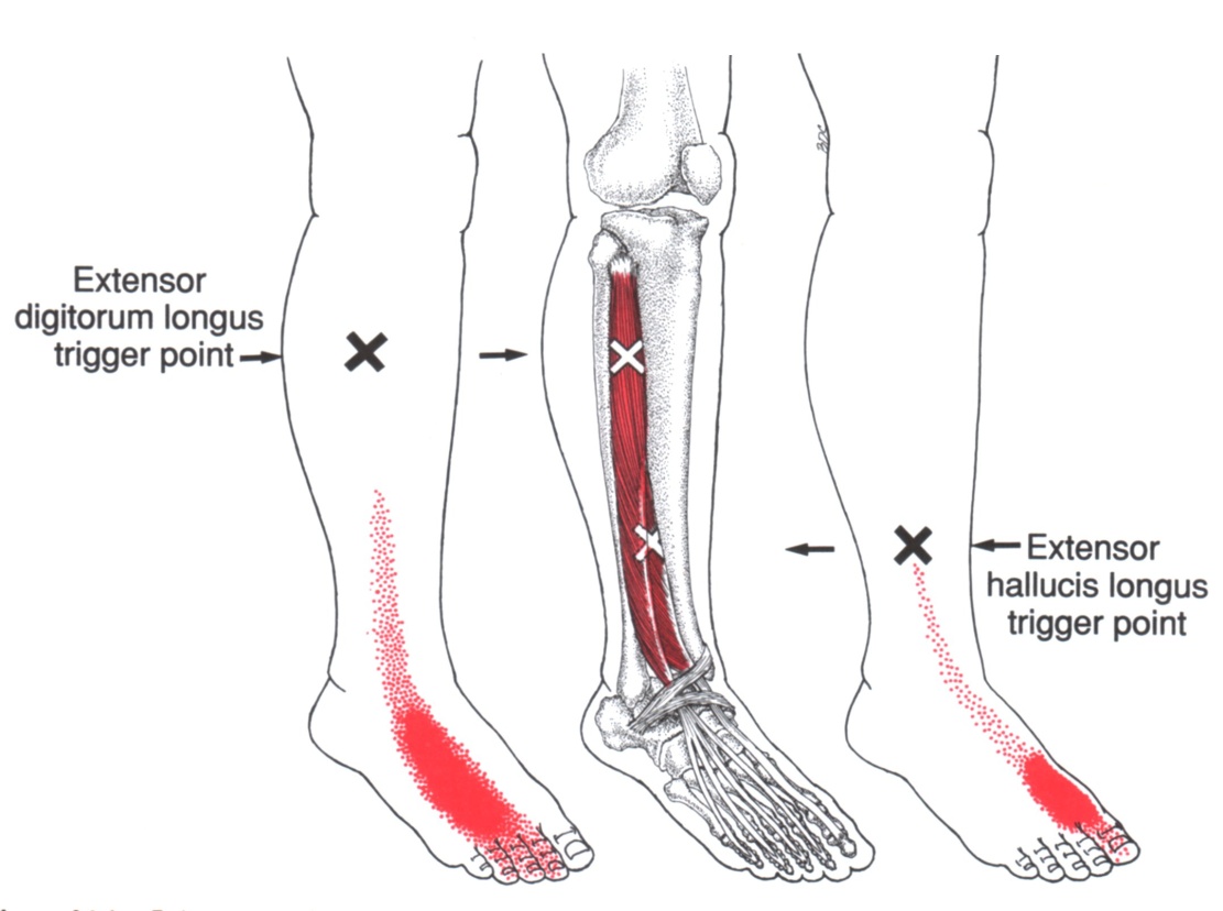 Extensor hallucis longus tendon injury