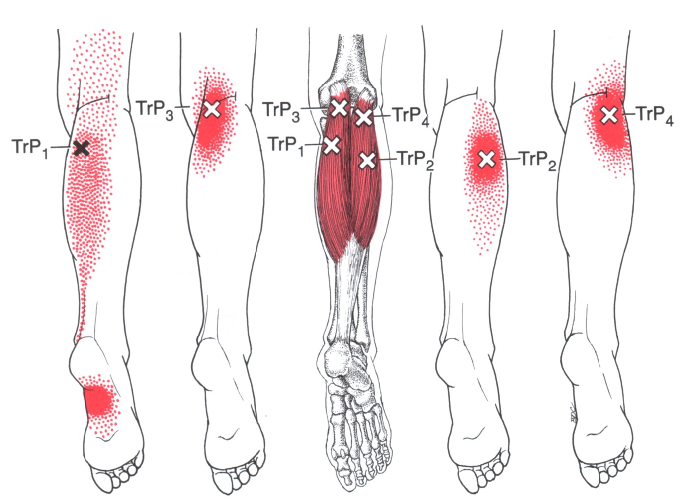 Trigger Point Chart Legs