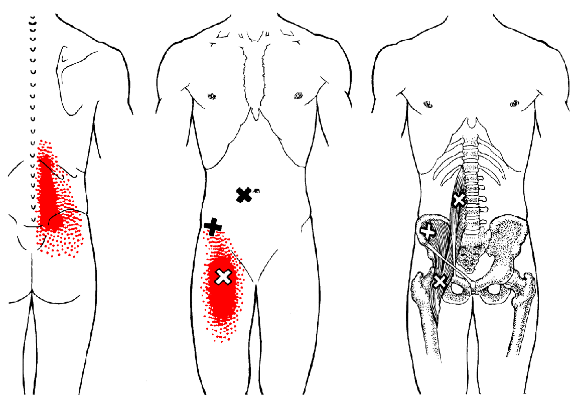 Hüftmuskel | The Trigger Point & Referred Pain Guide