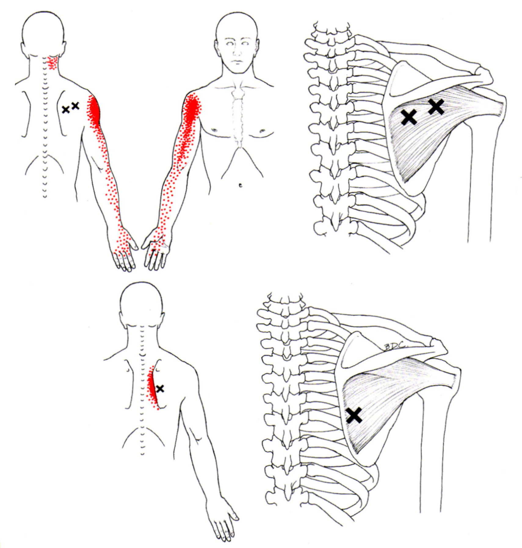 FST - Функционально-силовой тренинг: The Infraspinatus and Teres Minor