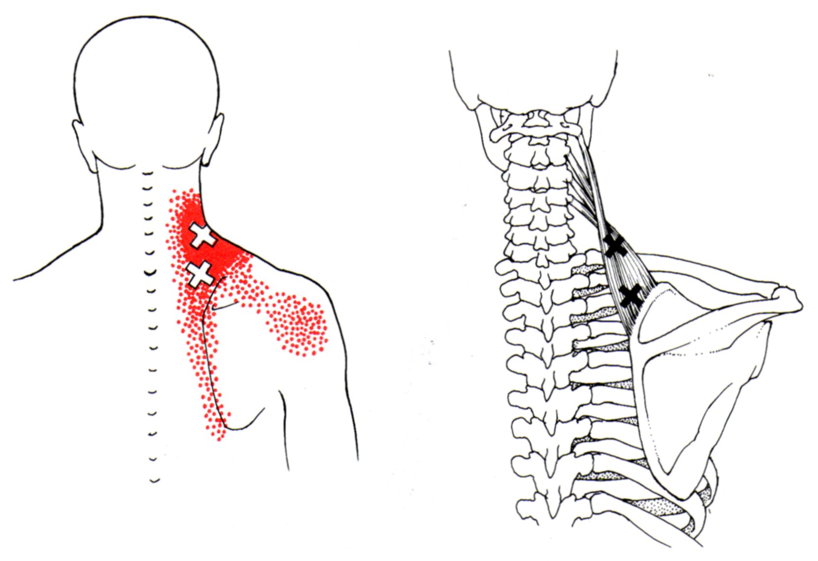 trigger points levator yoga anatomy