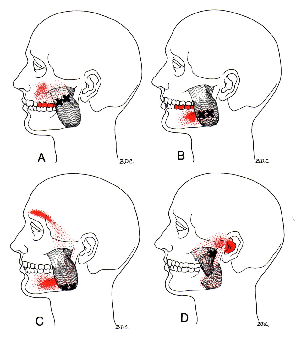 Trigger Point Referred Chart