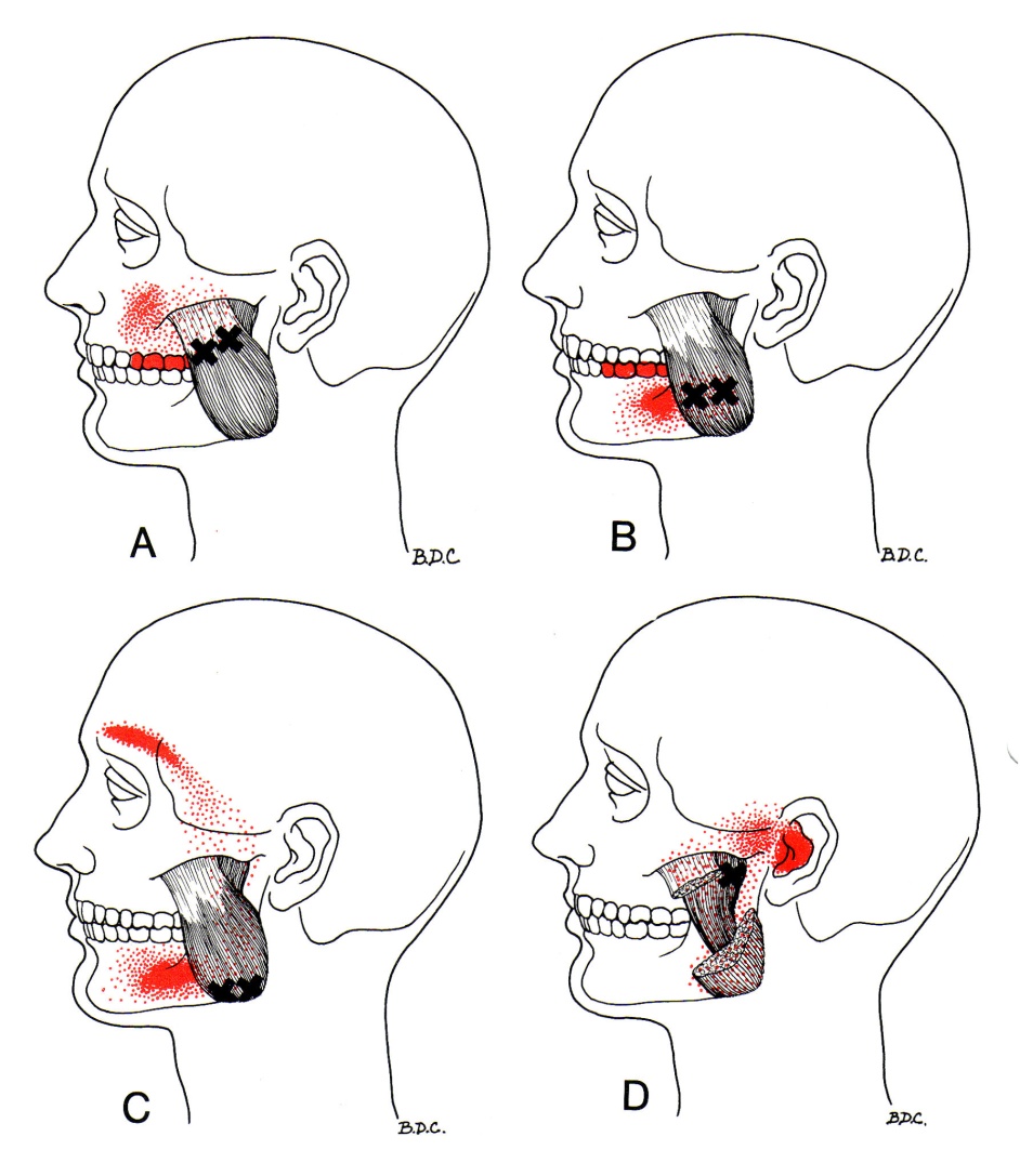 Referred Tooth Chart