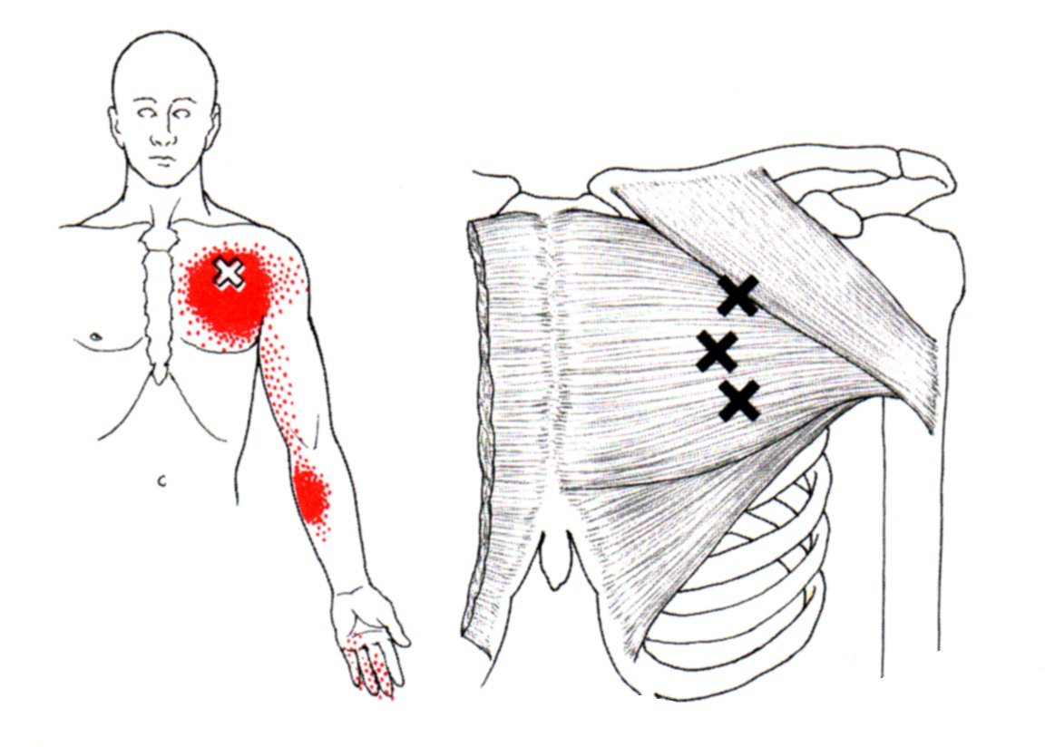 pectoralis major trigger point diagram