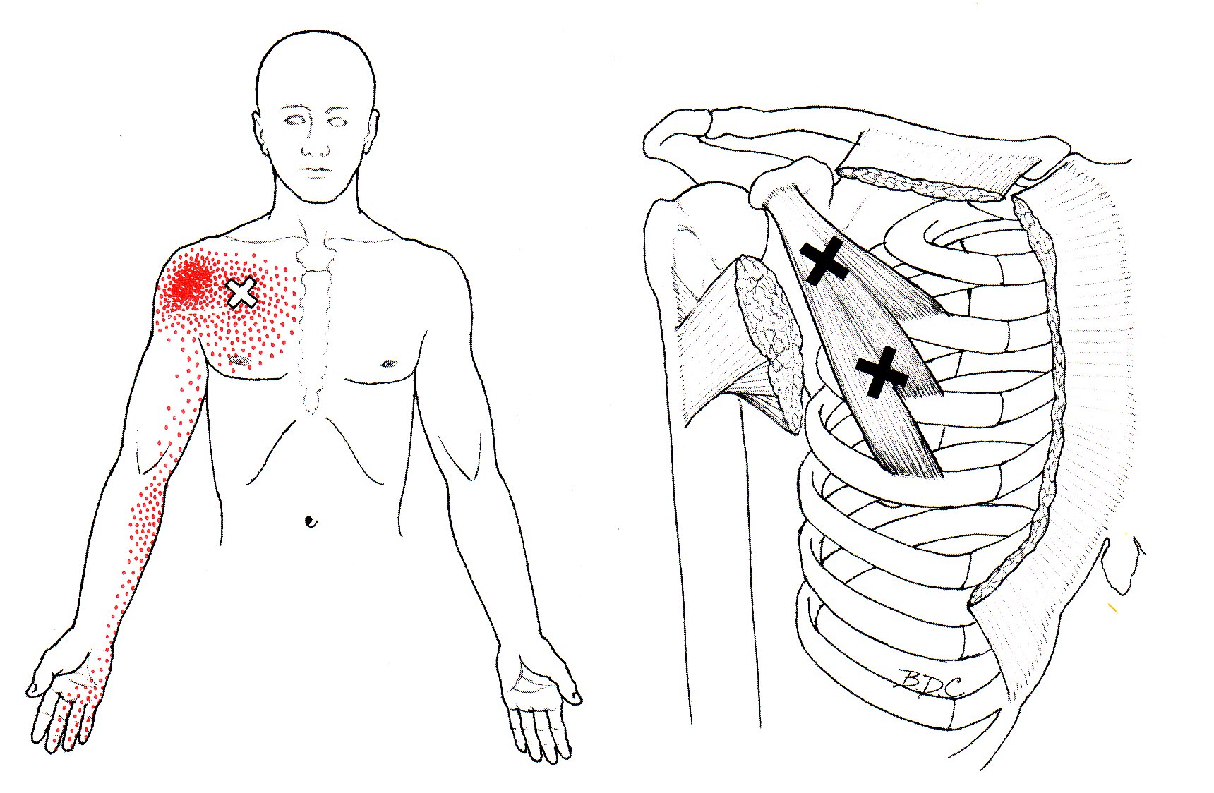 pectoralis minor trigger point diagram