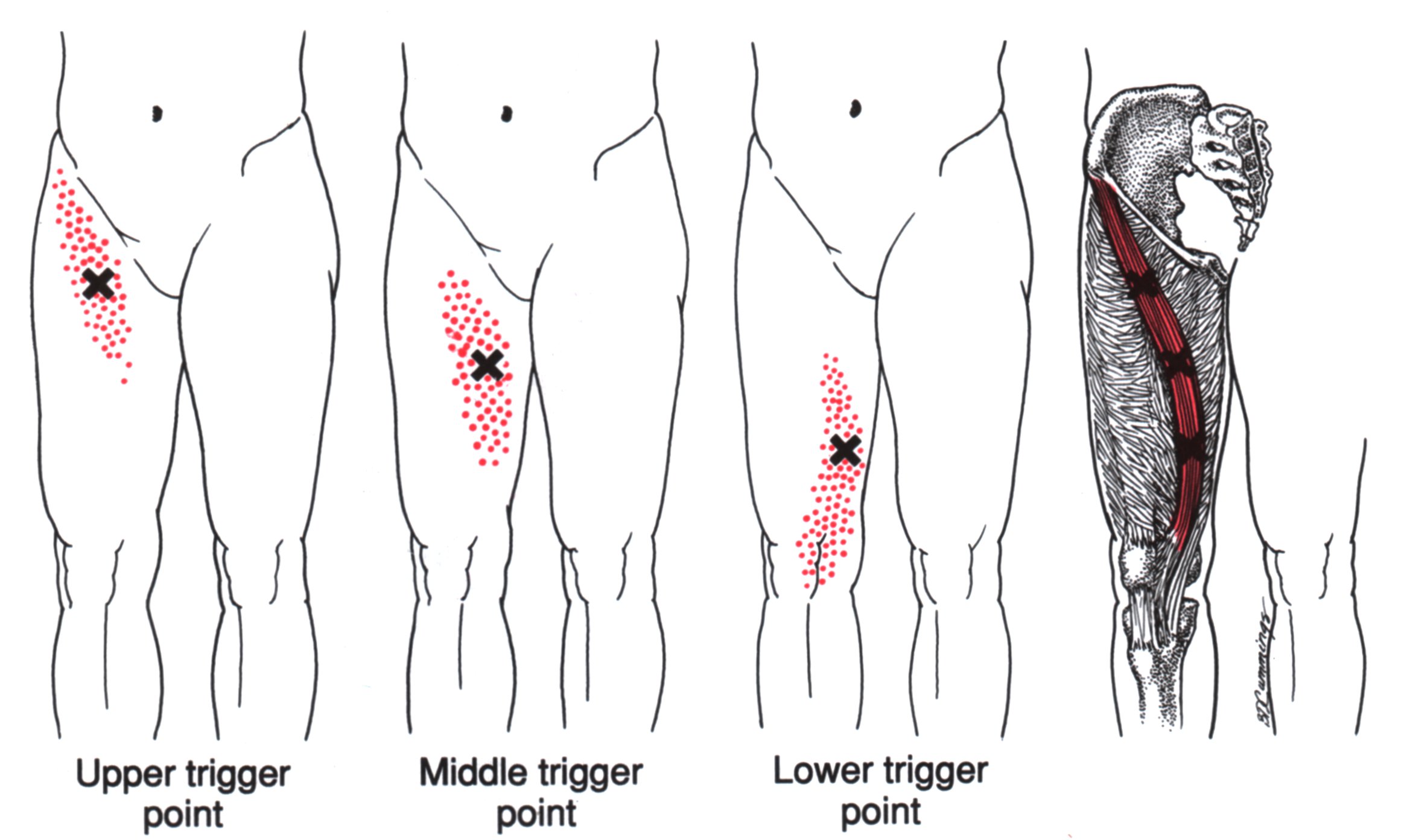 Oberschenkelleitmuskel | The Trigger Point & Referred Pain Guide