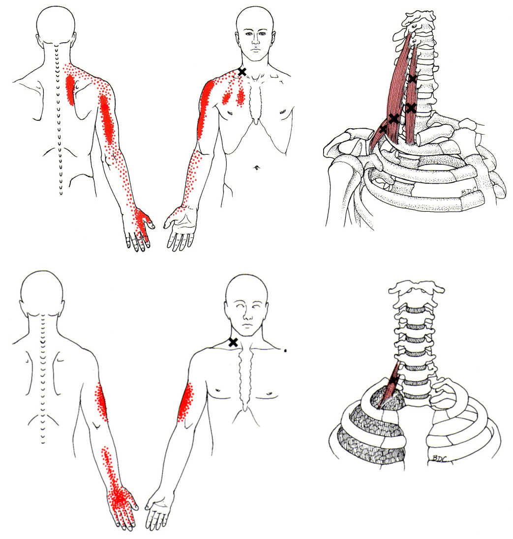 Trigger Point Referral Patterns Chart