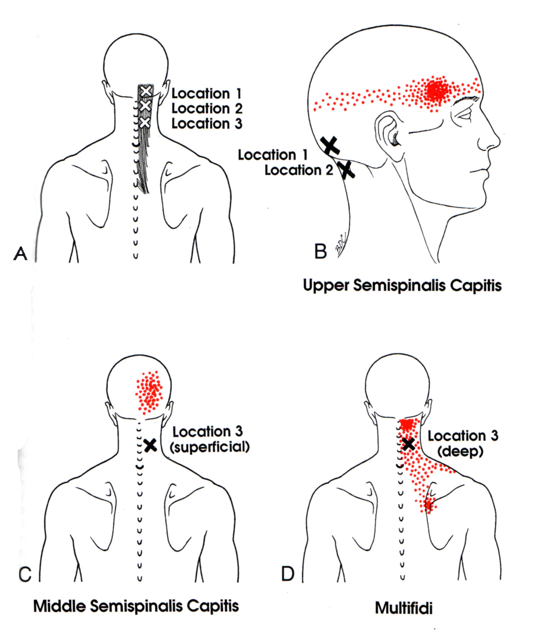 Semispinalis Capitis | The Trigger Point & Referred Pain Guide