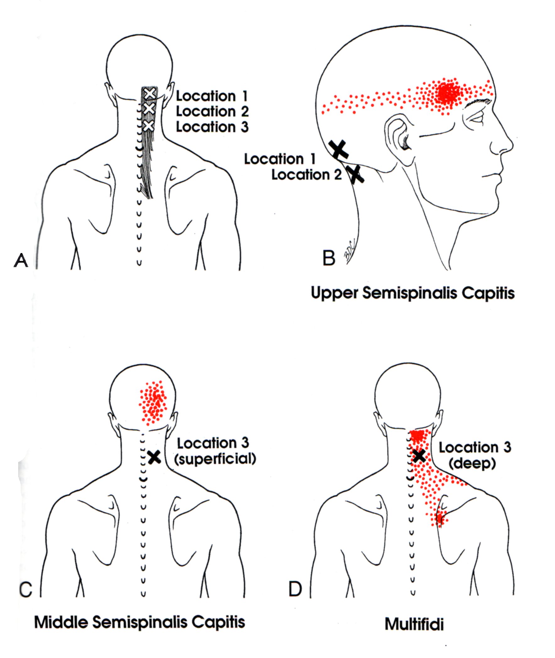 Trigger Points For Headaches Chart