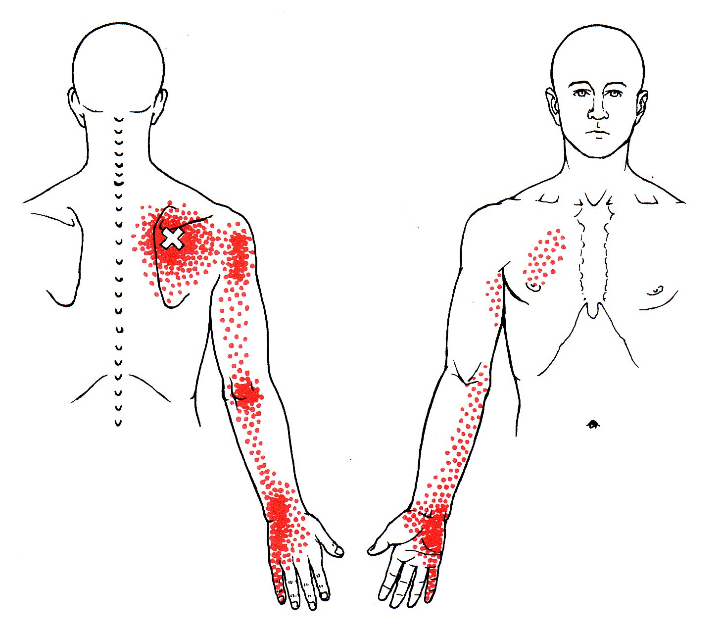 Trigger Point Referred Chart