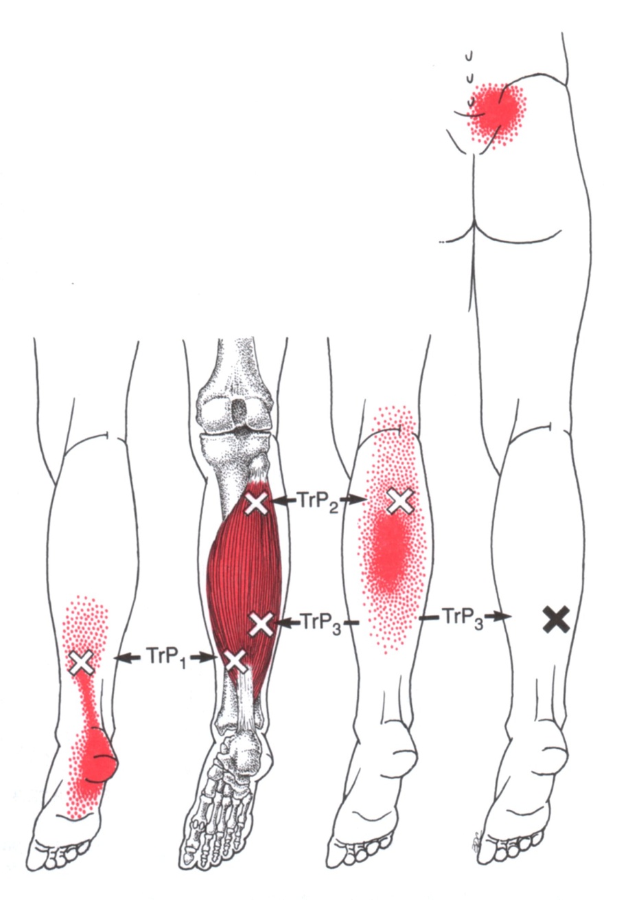 Trigger Point Referred Chart