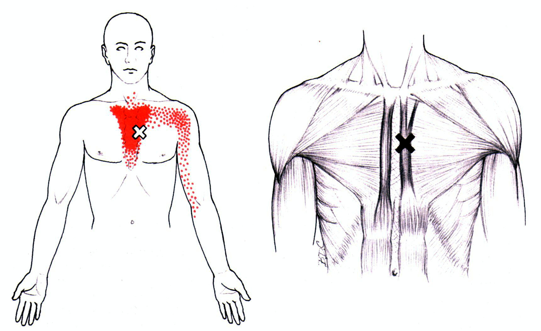 Trigger Point Referred Chart