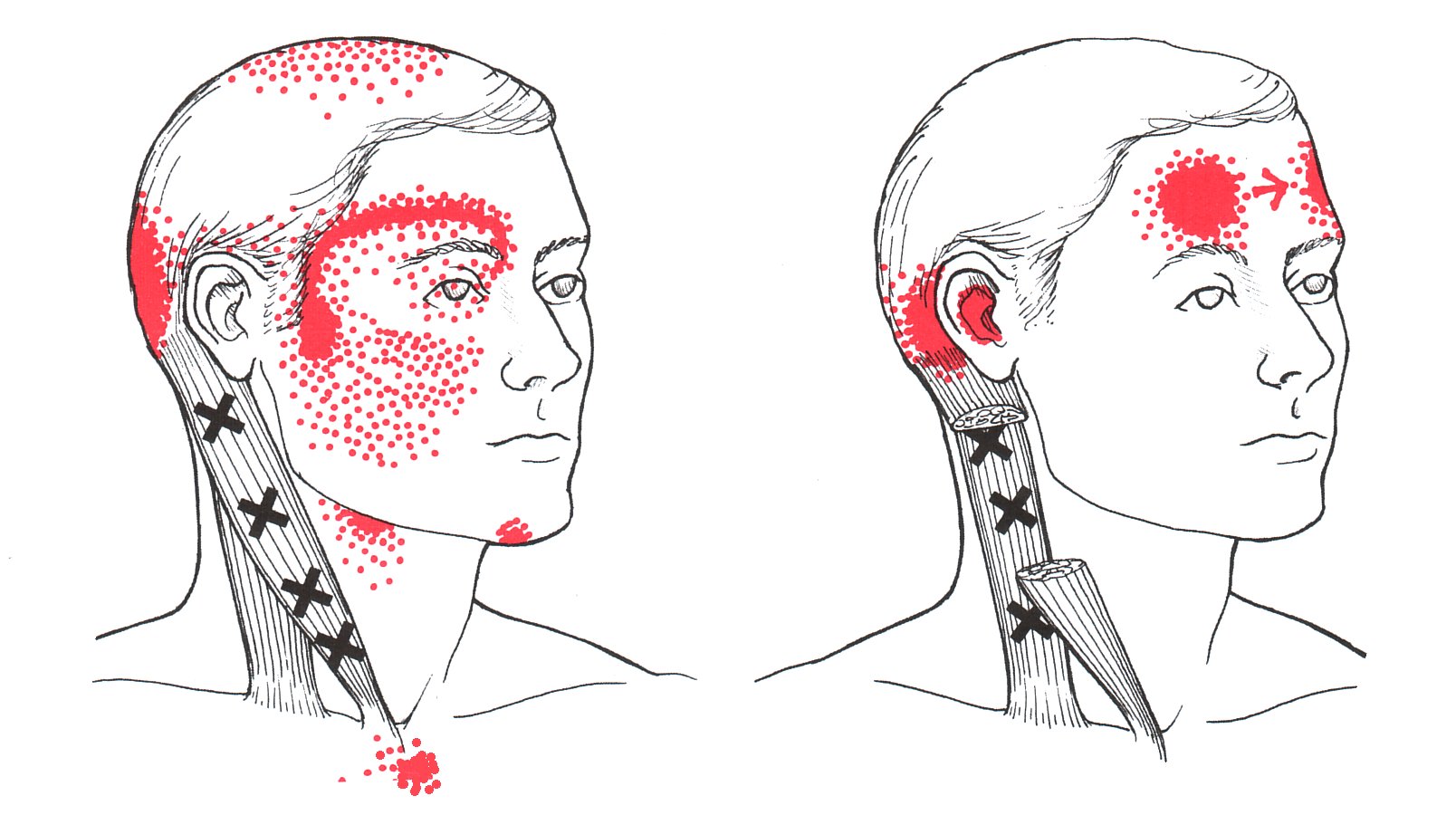 Sternocleidomastoid | The Trigger Point & Referred Pain Guide