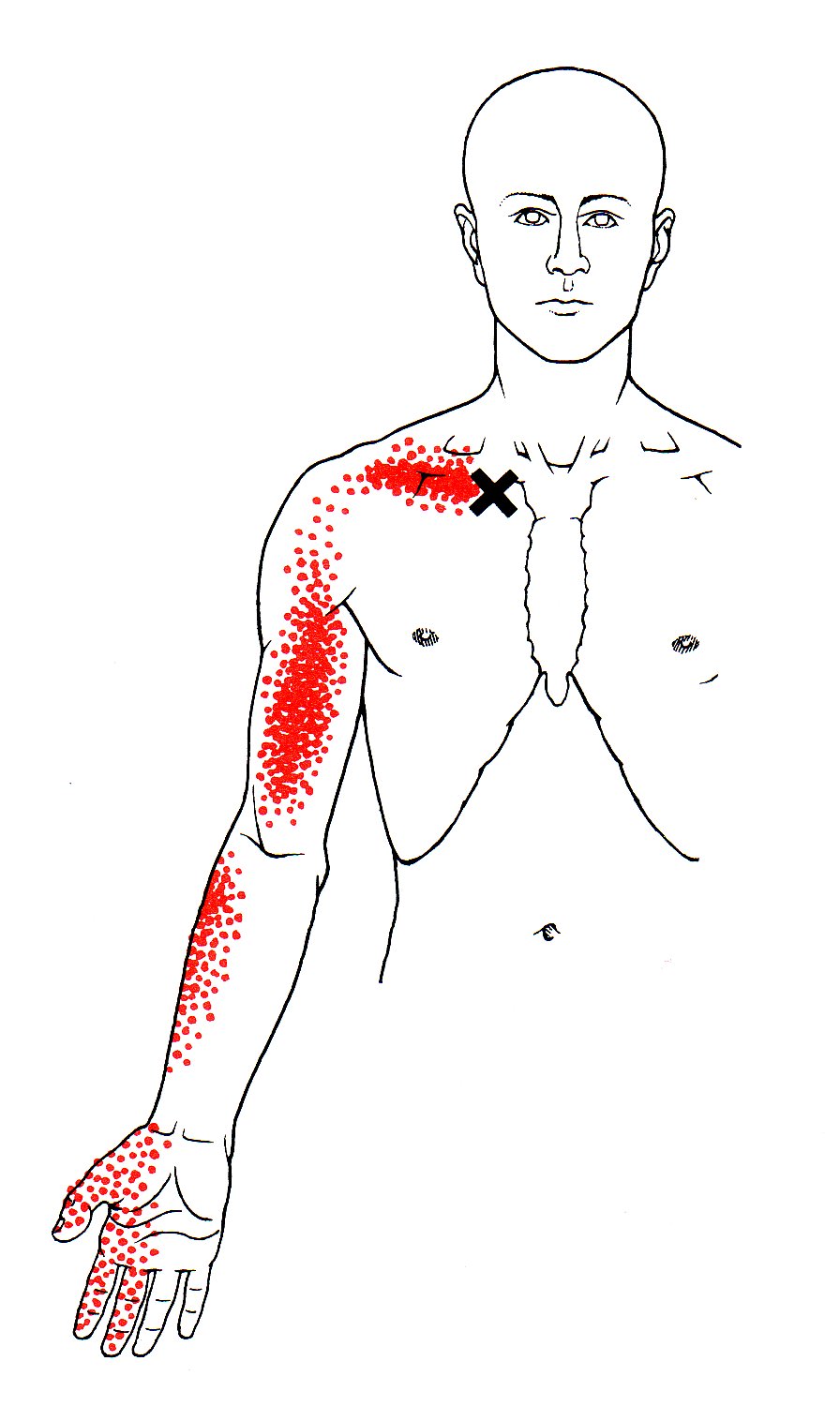 Trigger Point Referred Chart