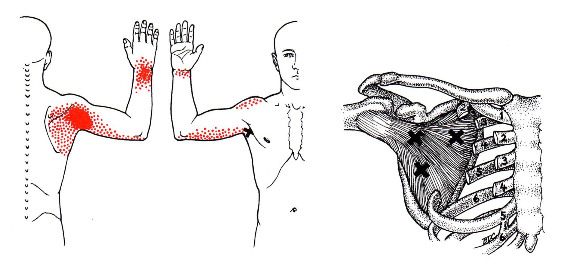 Subscapularis - rotator cufff muscle
