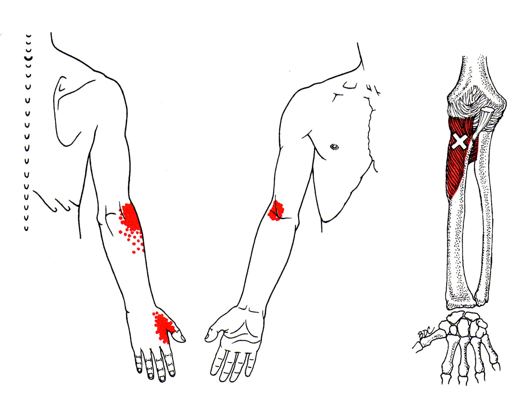 Supinator.jpg 1,720×1,320 pixels Trigger points Supinator.jpg 1,720×1,320 pixels Trigger points