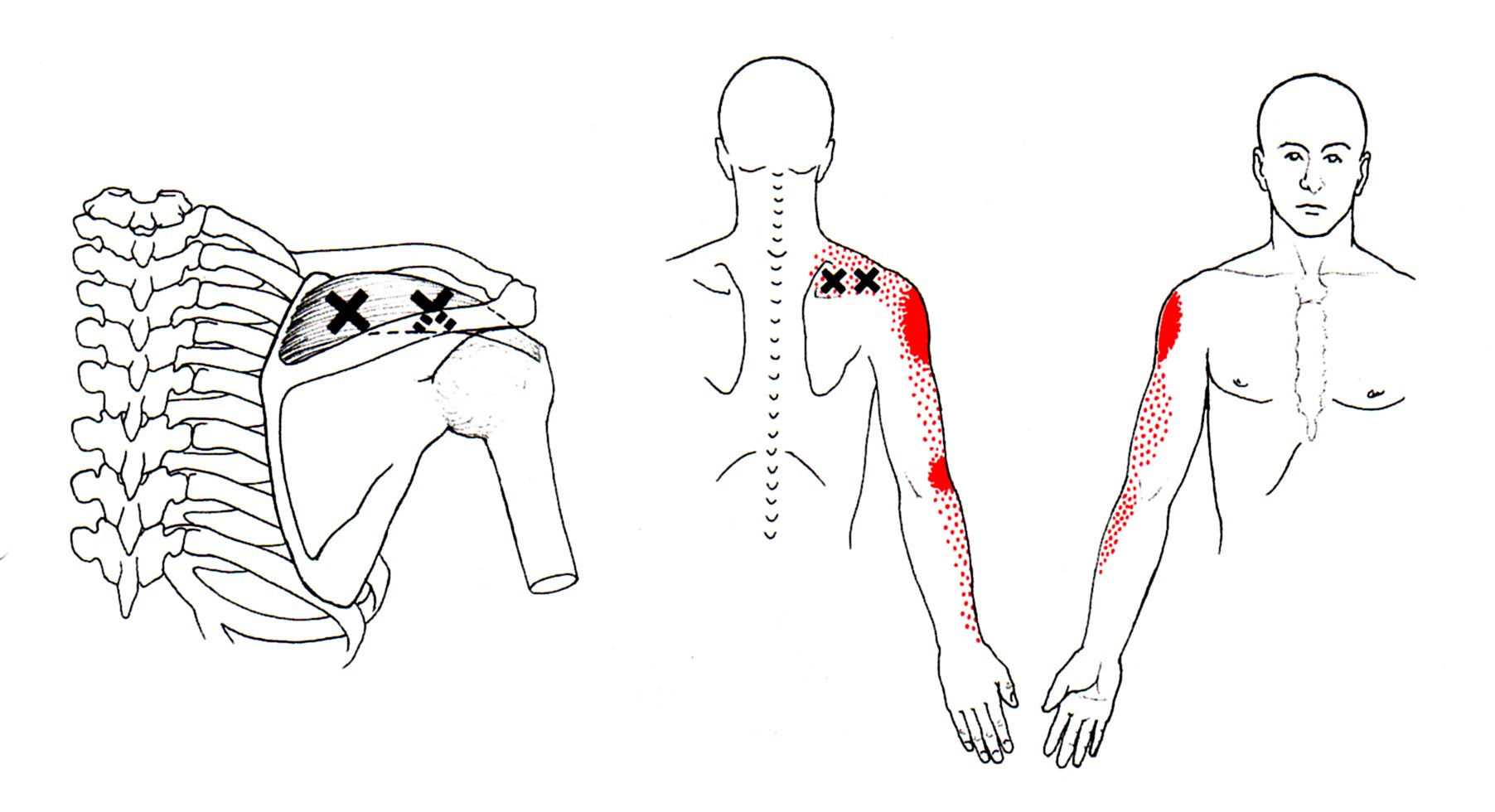 supraspinatus trigger points