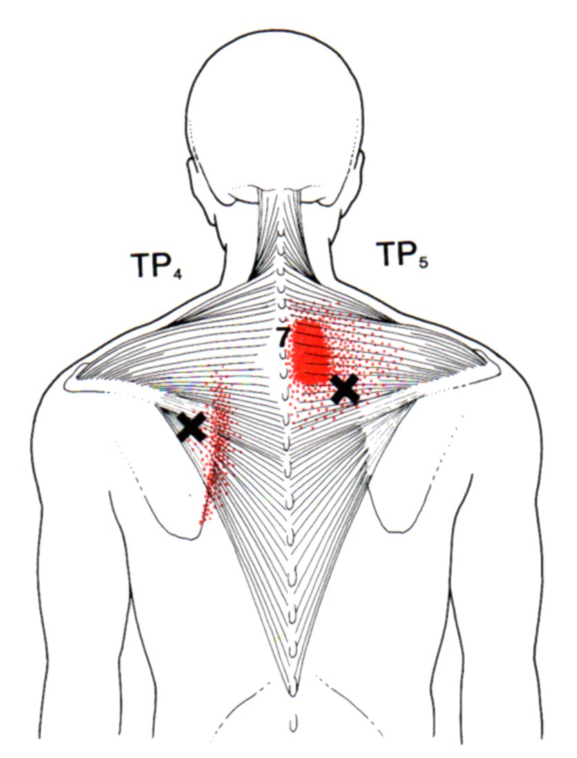 Trigger Points Chart Neck