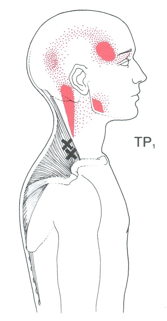 Trapezius | The Trigger Point & Referred Pain Guide