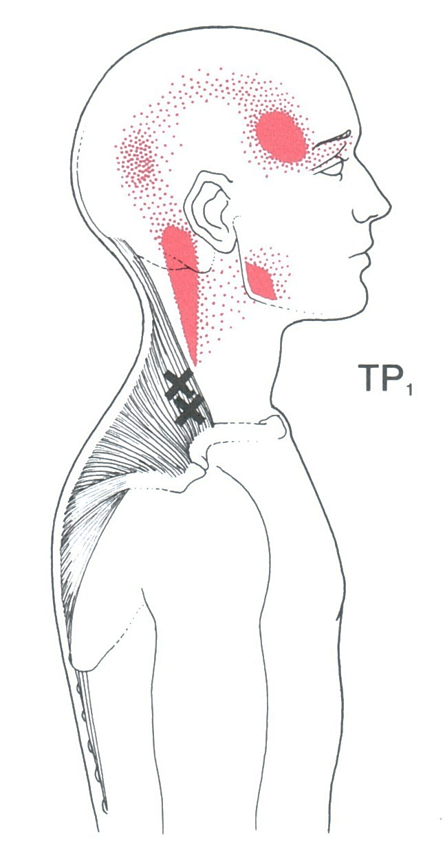 Trigger Points For Headaches Chart