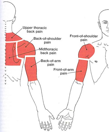 Upper Back, Shoulder, and Arm  The Trigger Point & Referred Pain