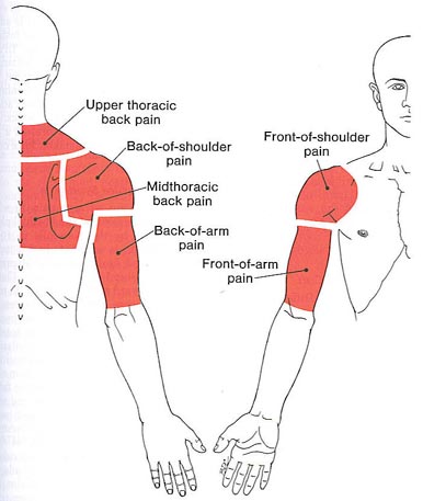 Shoulder Trigger Points Chart