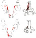 scalene (sometimes scalenes) referred pain diagram