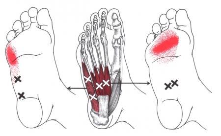 Trigger Point Referral Patterns Chart