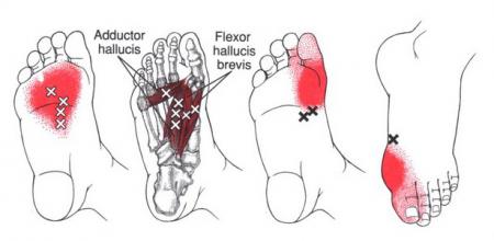 Triggerpoint referred pain diagram showing the adductor hallucis and the flexor hallucis brevis