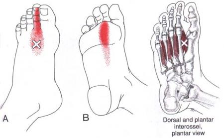 Referred Chart Foot