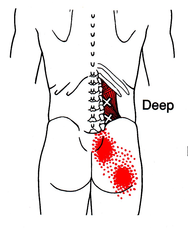 Quadratus Lumborum Muscle Spasm